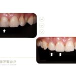 門牙蛀牙-抽神經-牙齒顏色不均-台中全瓷冠-推薦-御耀美學牙醫