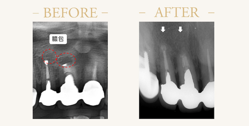 水雷射根尖切除手術前後，假牙牙齦膿包X光片比較
