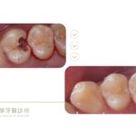 蛀牙洞-補蛀牙-蛀牙治療-3D齒雕-台中-推薦-御耀美學牙醫