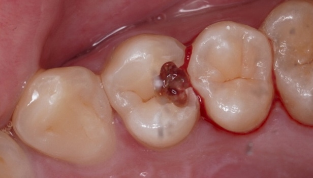 蛀牙洞下的嚴重蛀牙