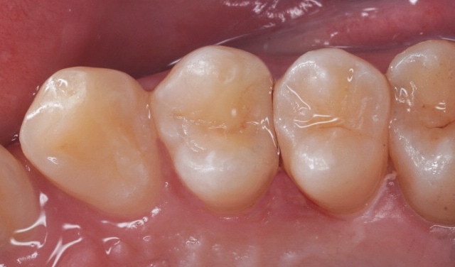 3D齒雕(陶瓷嵌體)三小時完整治療蛀牙