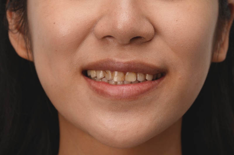 台北新娘張小姐全瓷冠、陶瓷貼片的術前牙齒，因補牙造成牙齒顏色不均影響美觀