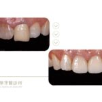 假牙不密合-金屬瓷牙-顯微根管治療-全瓷冠-台中-推薦-御耀美學牙醫