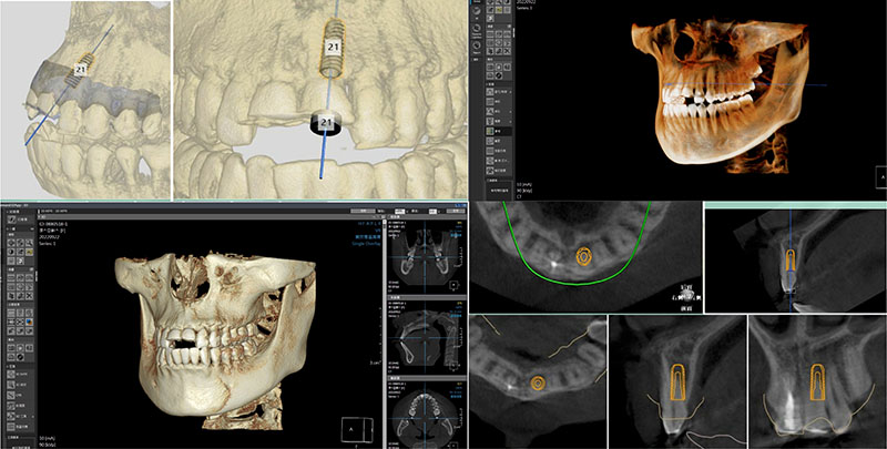 微創植牙結合CT(電腦斷層掃描)進行導航植牙，預先判斷拔牙後的位置，以及植體置入的位置與角度