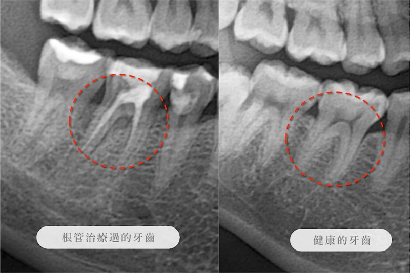 根管治療(抽神經)牙齒與健康牙齒X光比較圖