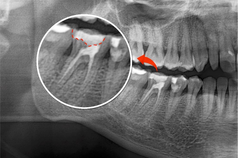 根管治療後X光片，做過根管治療的牙齒上有較大的填補物