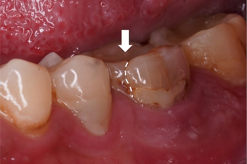 根管治療後牙齒裂開痕跡