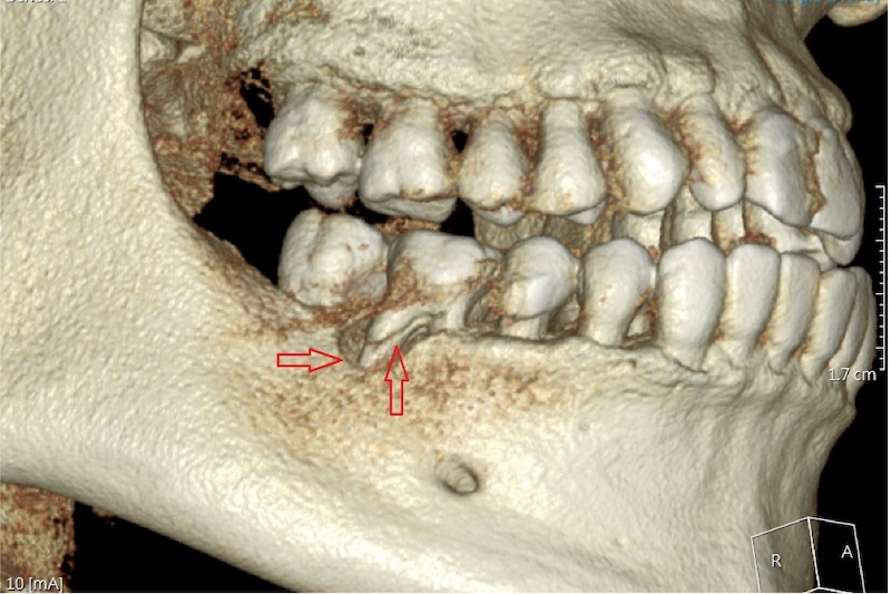 根管治療牙齒裂開斷裂至牙根，斷層掃描顯示齒槽骨也受到明顯破壞