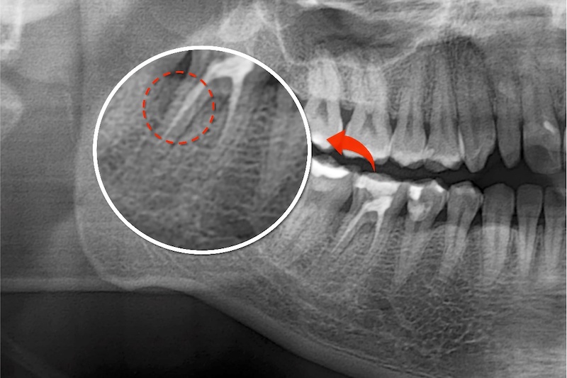 根管治療後X光片，做過根管治療的牙齒有骨頭吸收破壞的痕跡