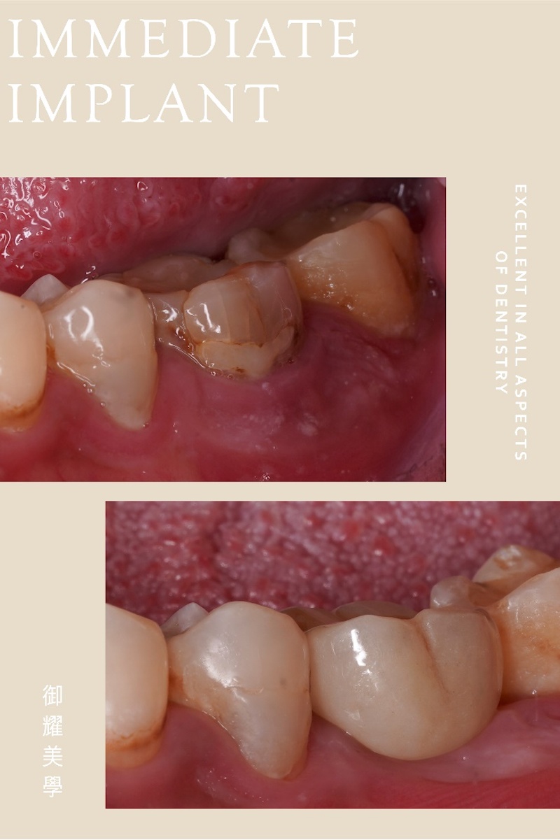 根管治療後牙齒裂開，採即拔即種補骨搭配全瓷冠假牙治療前後對比