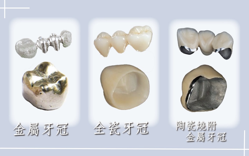 假牙材質種類：金屬牙冠、全瓷牙冠、陶瓷燒附金屬牙冠（金屬瓷牙）