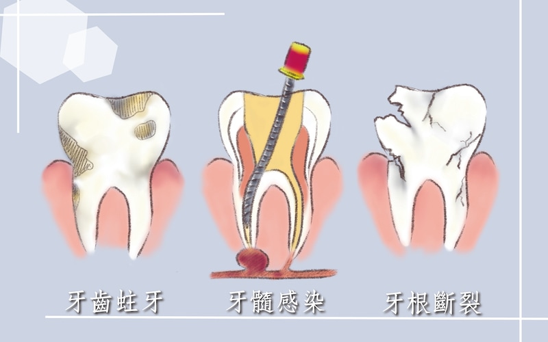 有牙齒蛀牙、牙髓感染、牙根斷裂等情況，推薦採全瓷冠修復