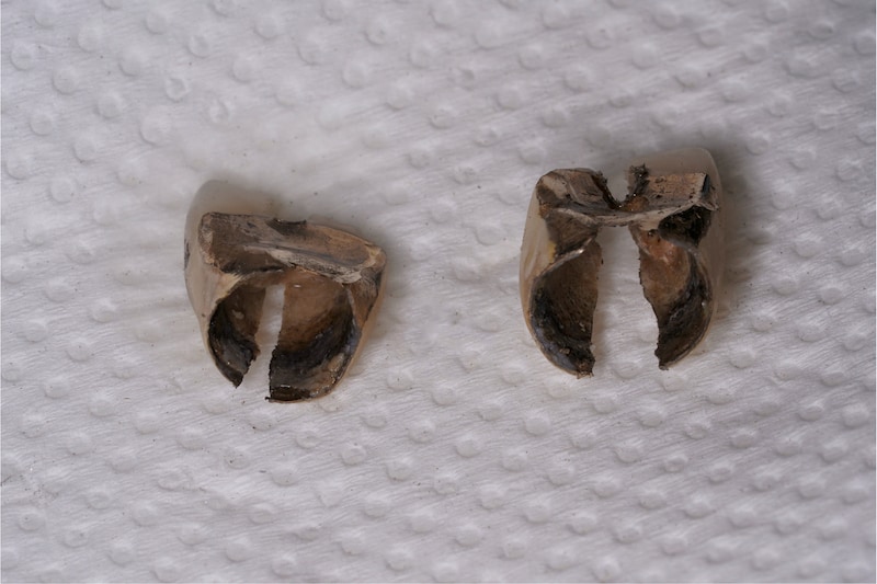 拆除後的陶瓷金屬假牙內部外觀，假牙內部氧化使假牙不密合，造成假牙內部蛀牙、牙齒變黑