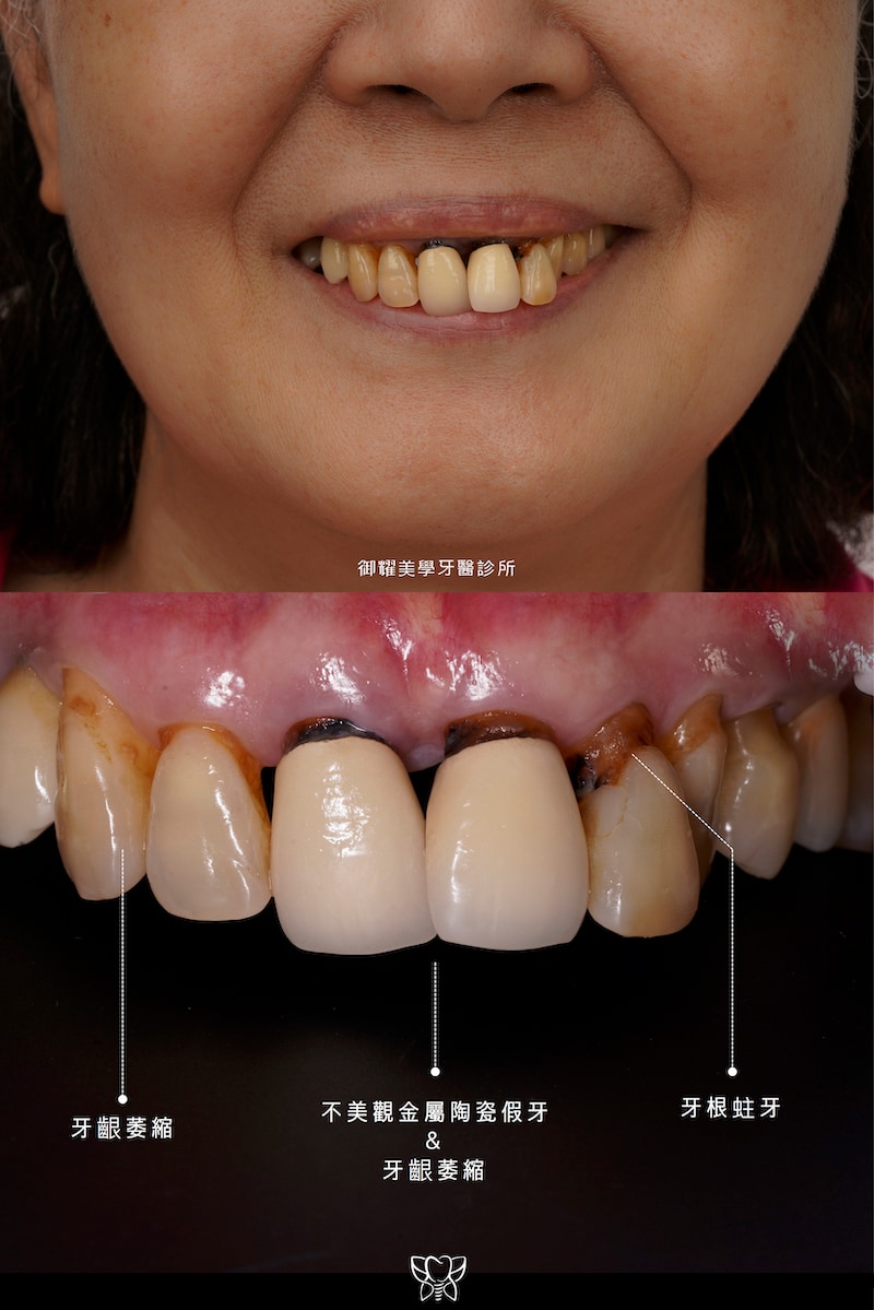 患者的前牙因牙周病導致牙齒移位，原本門牙的金屬陶瓷假牙變黑外暴，更有牙齦萎縮、牙根蛀牙等問題