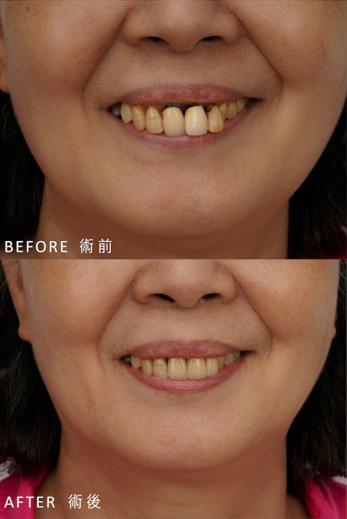治療前患者因牙周病牙齒位移，不密合的假牙出現變黑、蛀牙等問題；御耀美學卓院長為她重做假牙，重建健康美觀笑容