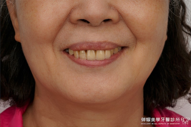 御耀美學卓院長為患者重做假牙，拆掉不密合的舊假牙，重建健康美觀笑容