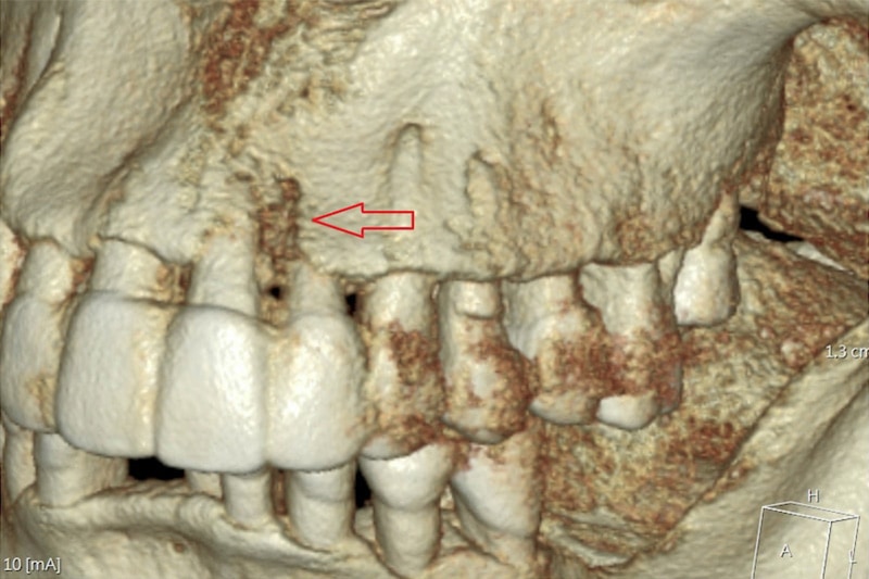 牙周病造成牙齒移動、牙齒搖晃，在斷層掃描下可見異常的骨頭吸收狀況