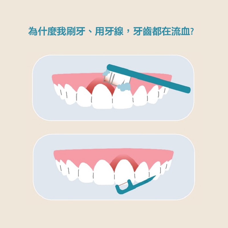 刷牙、用牙線牙齦流血示意圖