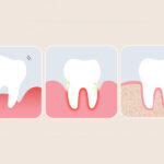 牙周病-症狀-治療-水雷射牙周病-台中牙周病治療-推薦-御耀美學牙醫