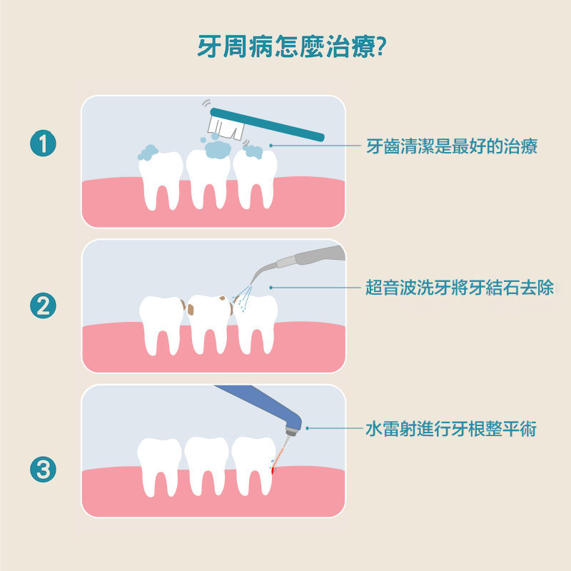 牙周病治療方式：確實做好牙齒清潔、超音波洗牙去除牙結石、水雷射牙根整形術