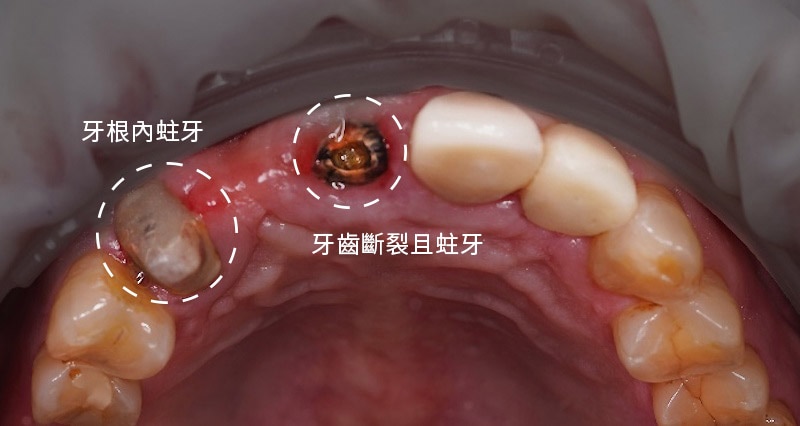 假牙內部牙齒蛀牙、斷裂，犬齒牙根內也都是蛀牙，預計拔牙後採微創植牙重建