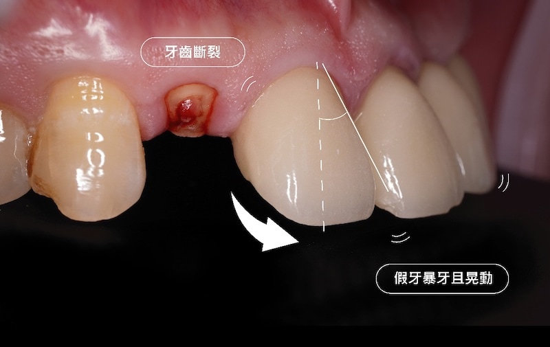 台中市潭子區患者黃先生的局部前牙近照，假牙搖晃且呈現暴牙外觀，並有門牙斷裂問題