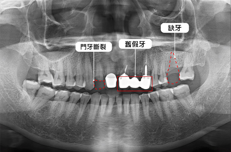 台中市潭子區患者黃先生的全口X光片，前牙有一組假牙，並有門牙斷裂、植牙失敗造成的缺牙等問題