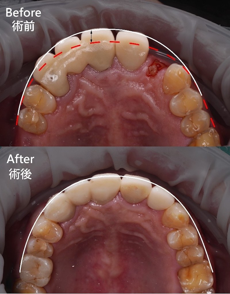 台中市潭子區患者黃先生術前的假牙因設計不良導致外觀突出，御耀植牙術後改善排列美觀