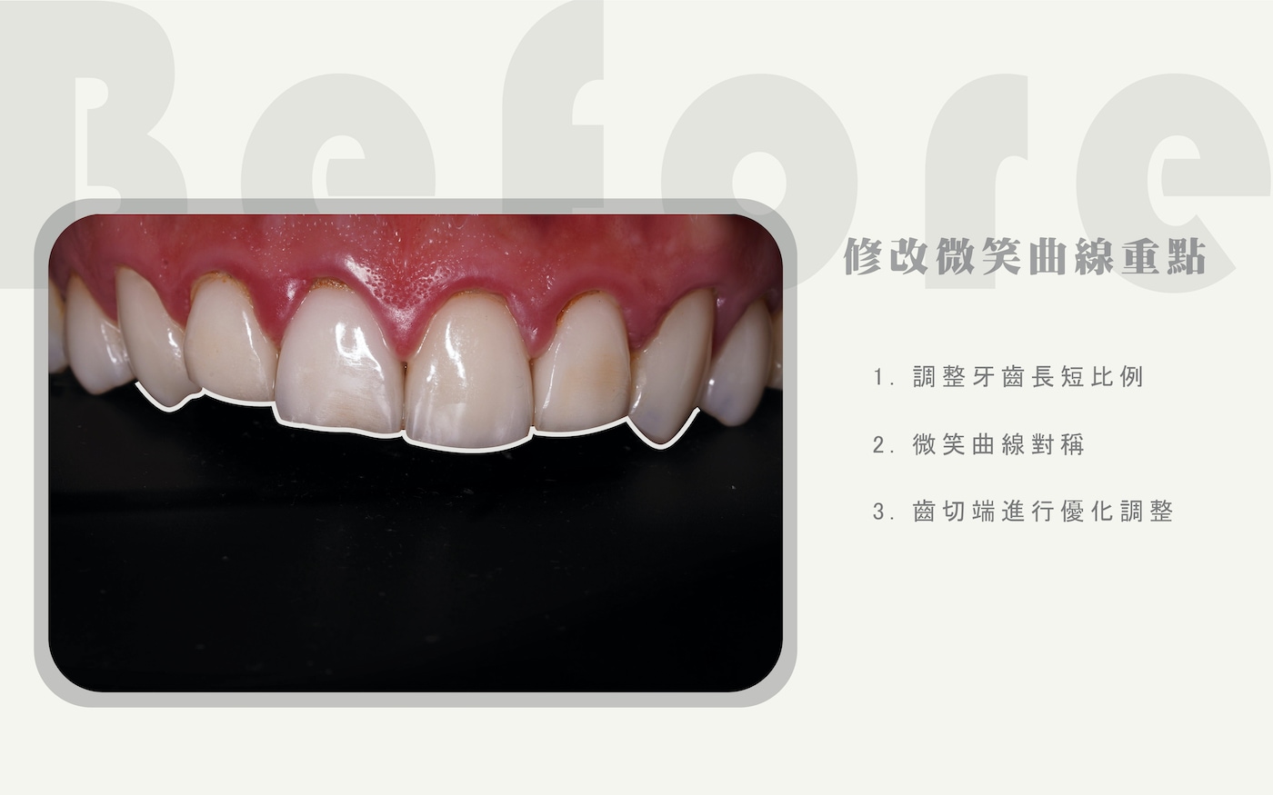 卓院長分析李唯楓的微笑曲線修改重點，包含調整牙齒長短比例、微笑曲線對稱、牙齒切端優化調整