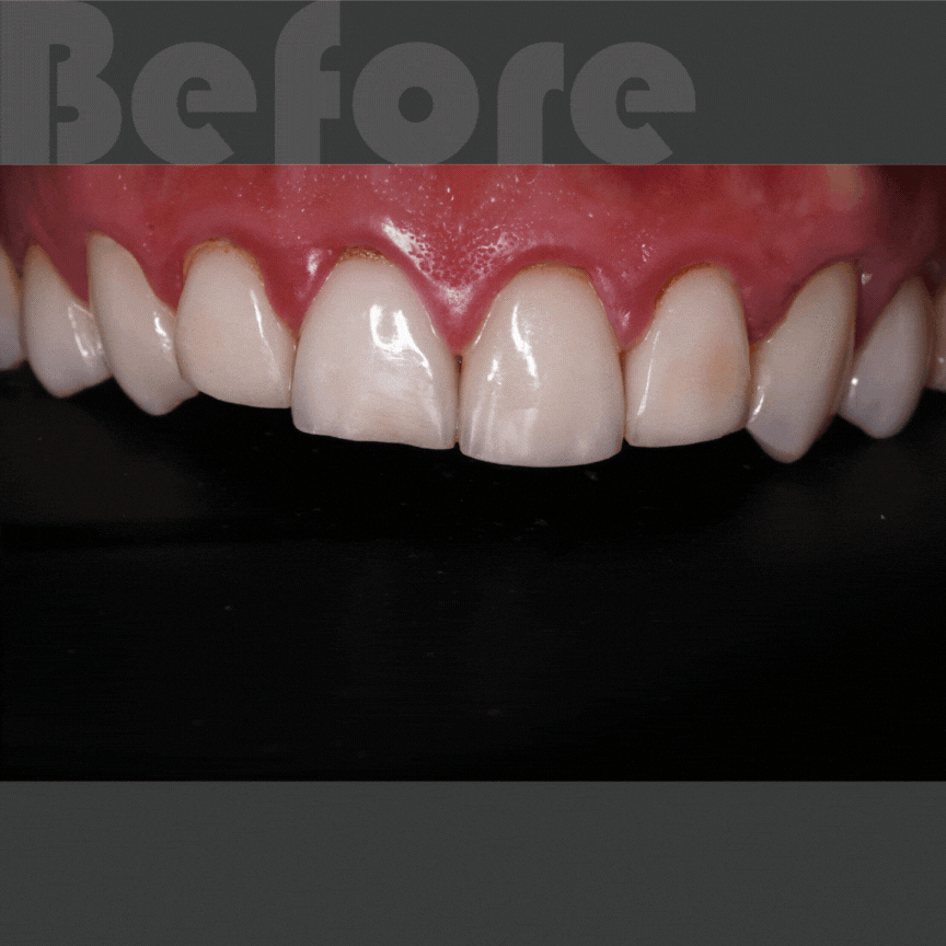 明星李唯楓重做陶瓷貼片療程前，還有牙齦萎縮、牙齦浮腫等問題
