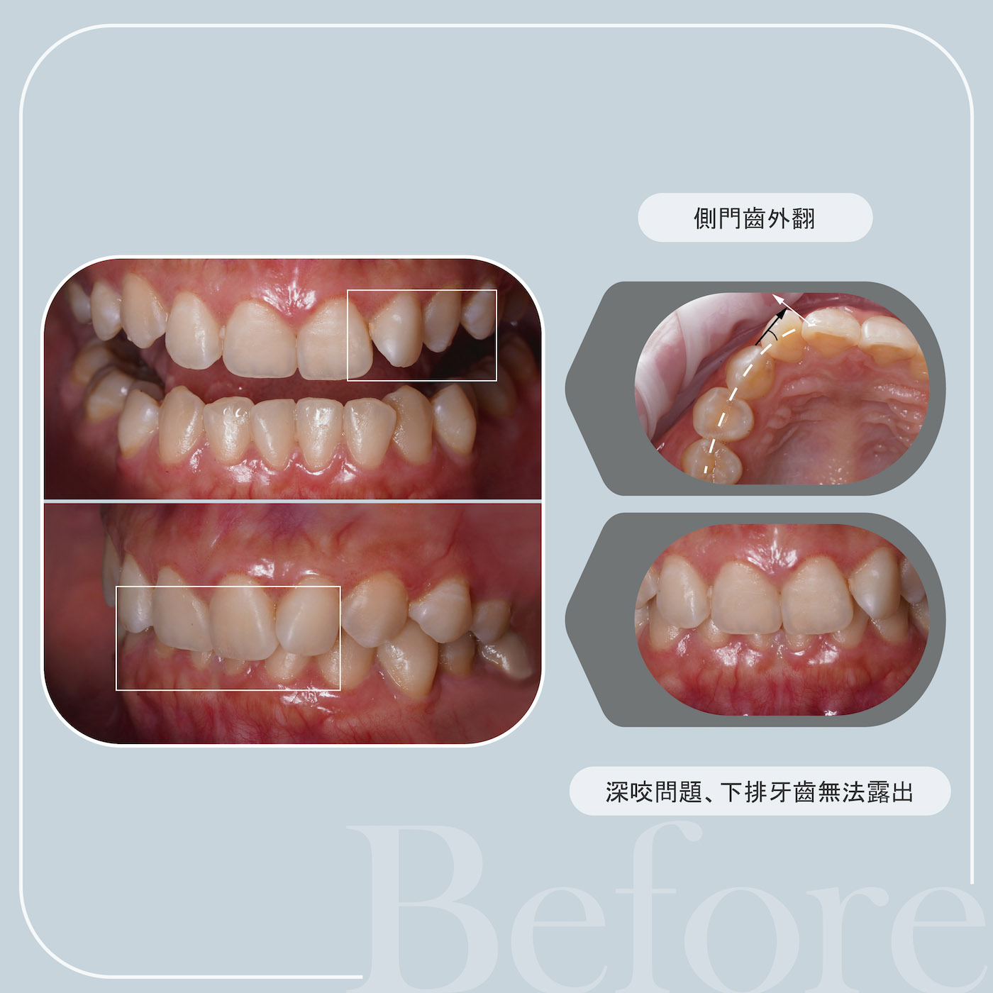 患者治療前的牙齒外觀：上排側門牙外翻，深咬也蓋住下排牙齒
