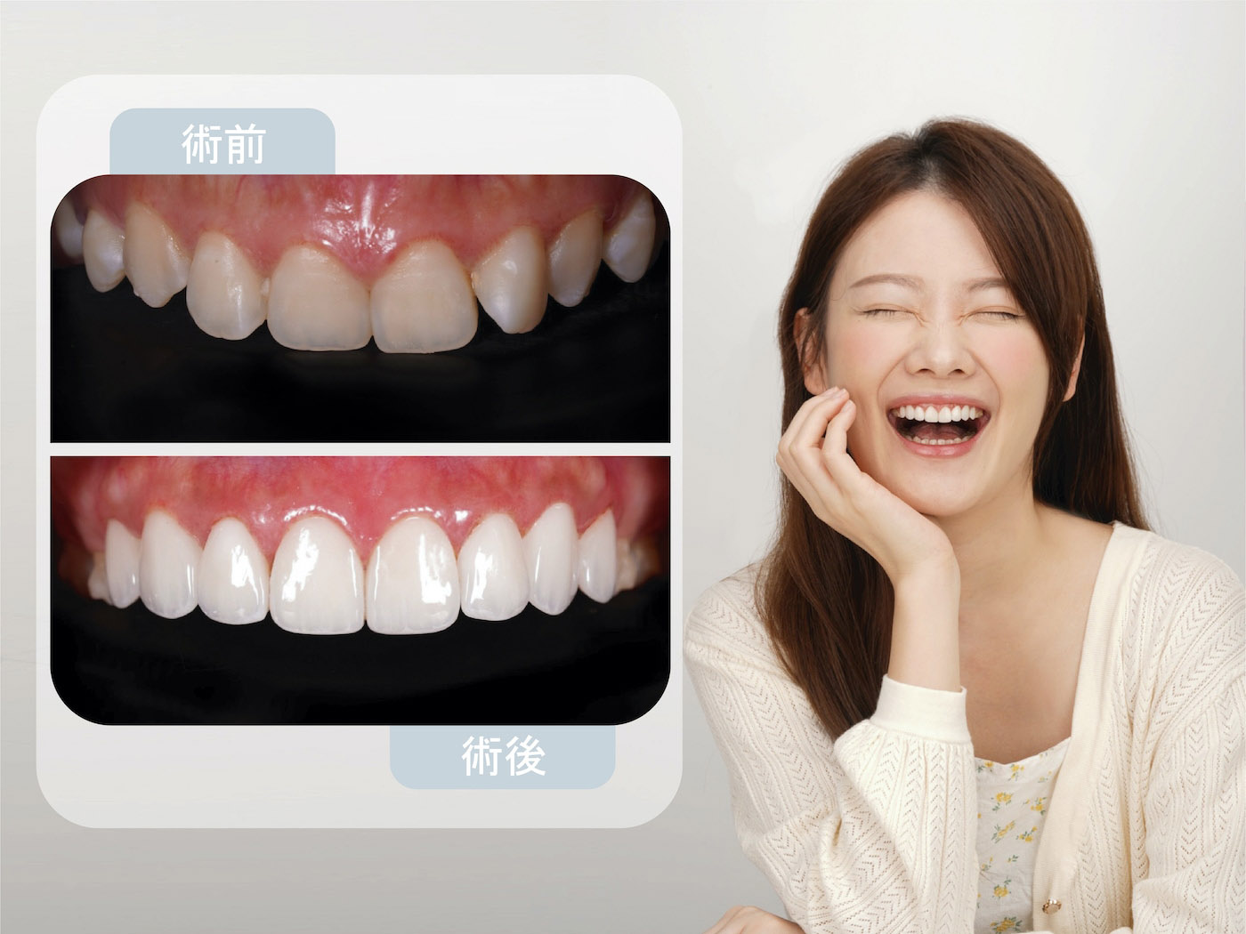 完成隱適美Lite與陶瓷貼片，患者牙齒變得整齊白皙透亮，露出完美笑容