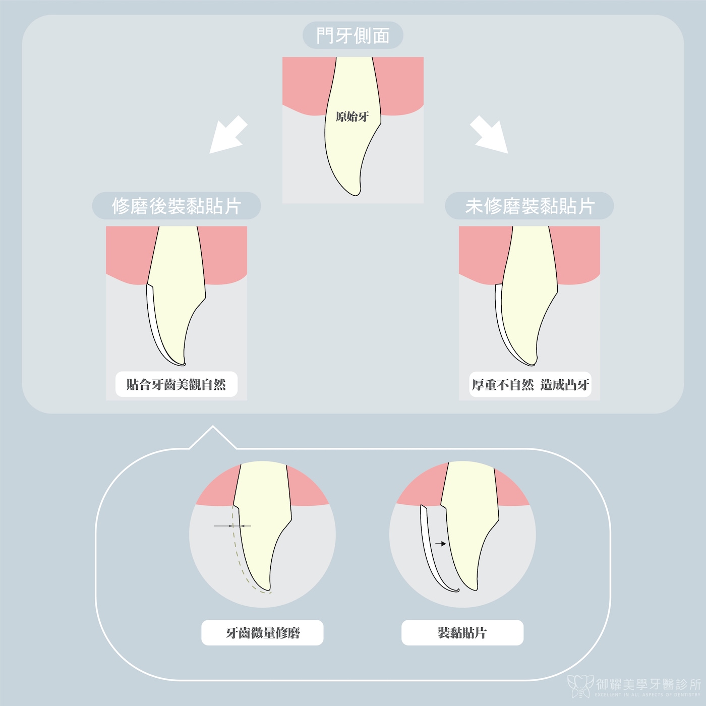 陶瓷貼片磨牙與未磨牙的比較示意圖：微量磨牙創造出貼片空間，貼片將貼合牙齒，外觀自然美觀；未磨牙直接裝戴貼片，會導致外觀厚重不自然