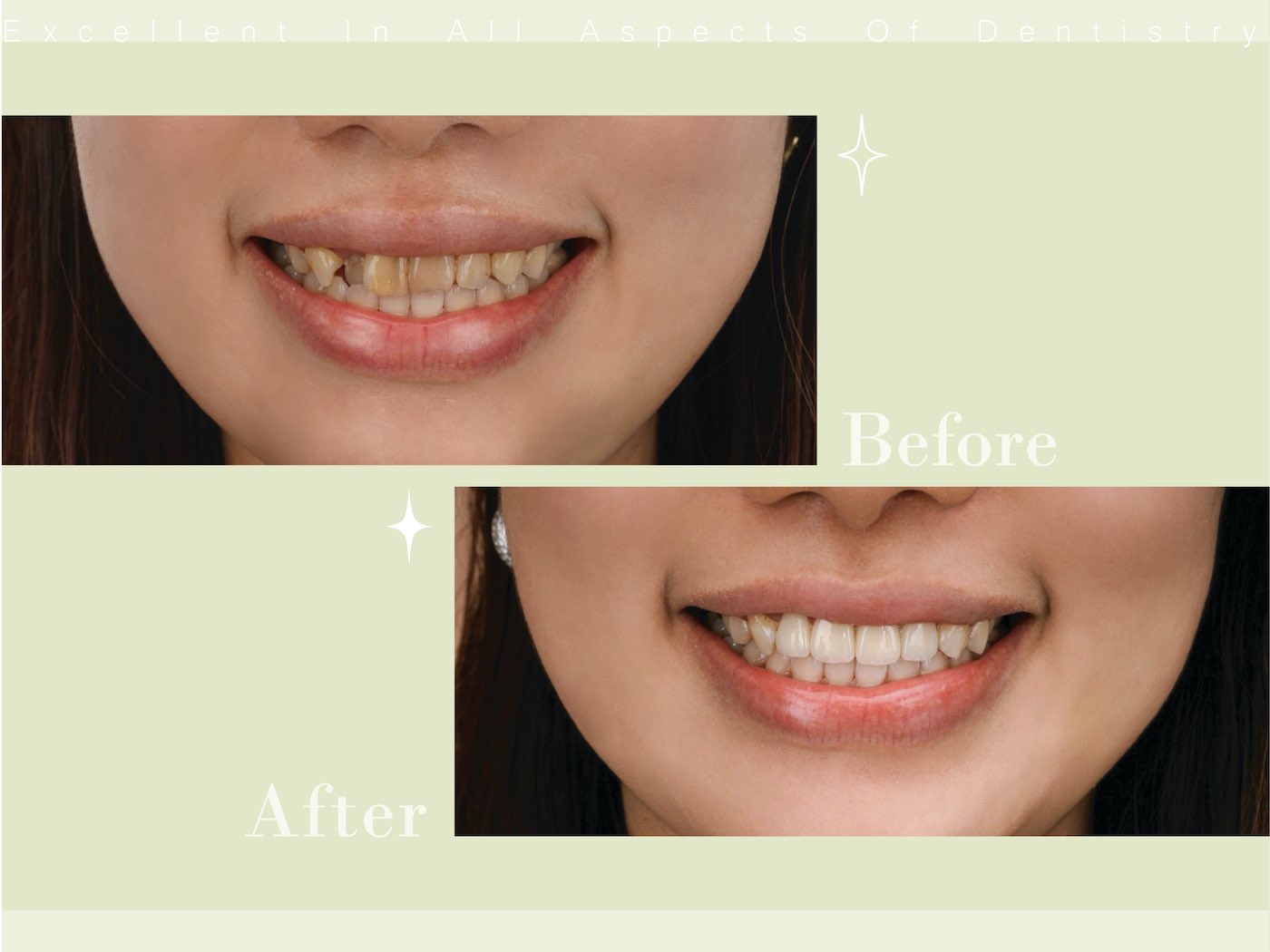 全瓷冠療程前後微笑曲線對比，牙齒變得整齊、齒色自然透亮