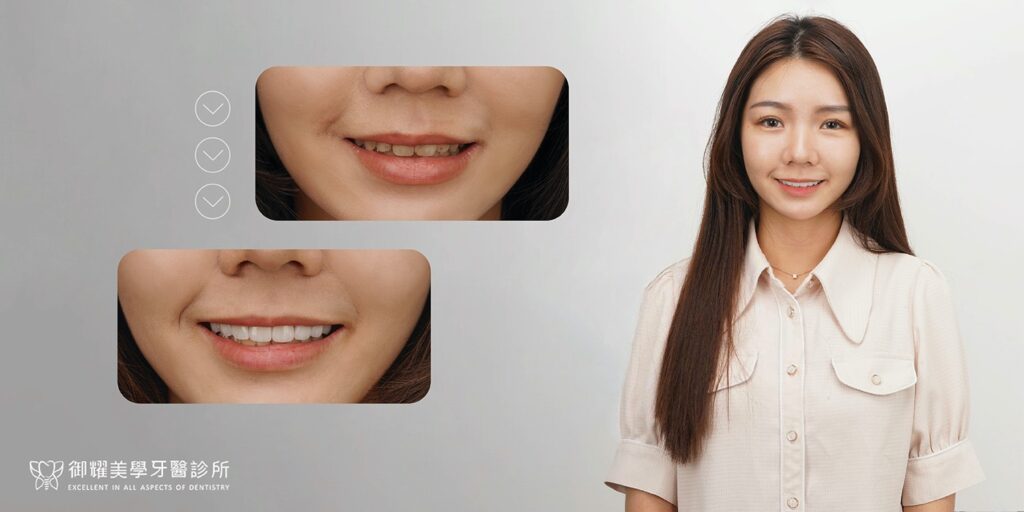 牙齒矯正-牙齒黃-蛀牙-陶瓷貼片-牙齒微笑曲線-台中-推薦-御耀美學牙醫