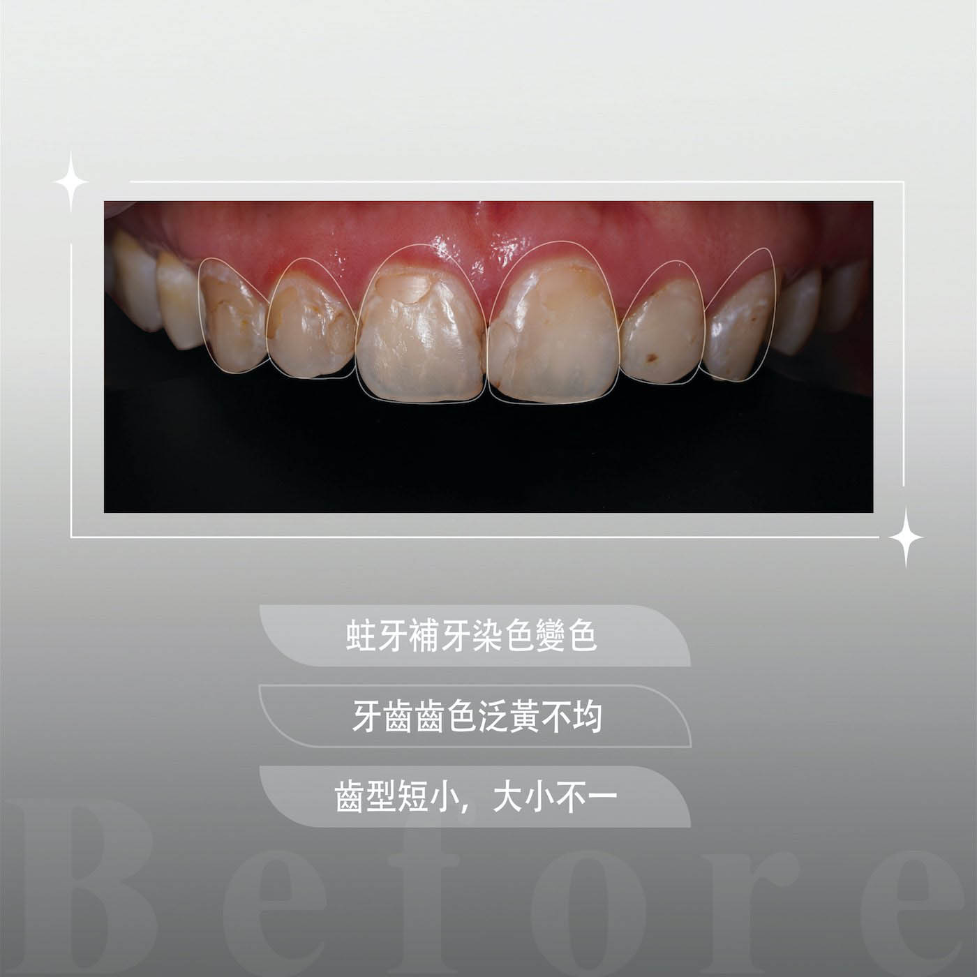 療程前的上排牙齒外觀，有牙齒黃、蛀牙補牙染色變色、齒型短小且大小不一等問題
