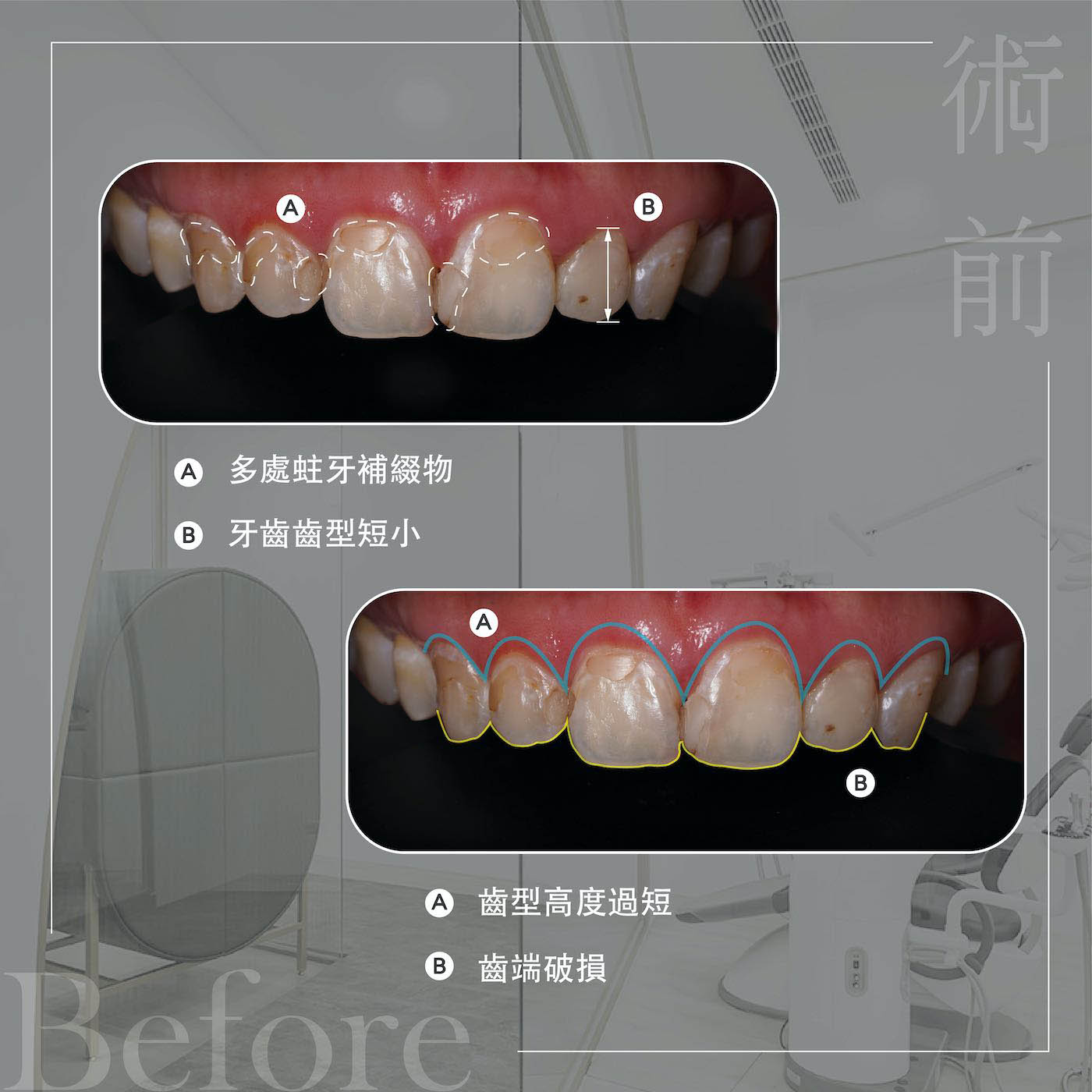 療程前上排牙齒外觀，矯正後仍有牙齒黃、蛀牙補牙變色、牙型短小等問題
