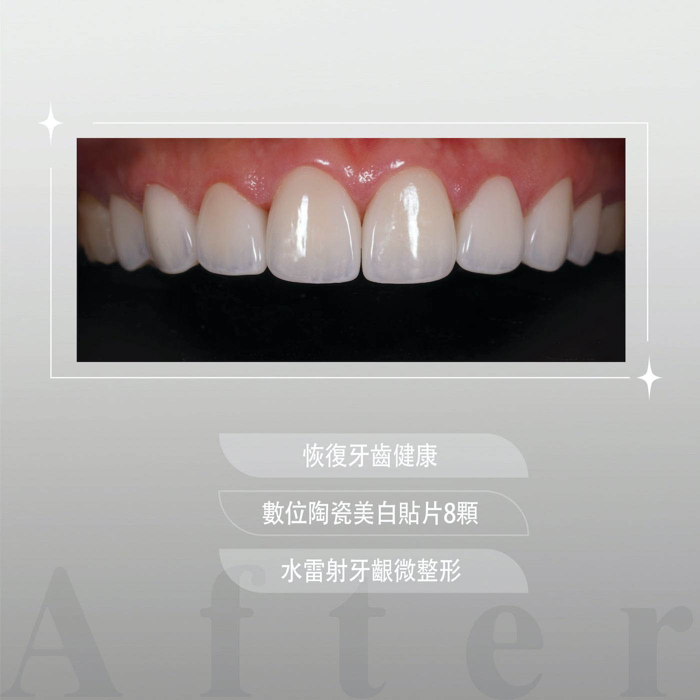 療程後上排牙齒外觀，以8顆陶瓷貼片搭配水雷射牙齦微整形，一次完成牙齒美白、重建微笑曲線並恢復牙齒健康