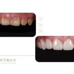 牙齒黃-牙齒短小-陶瓷貼片-水雷射-牙冠增長術-台中-推薦-御耀美學牙醫