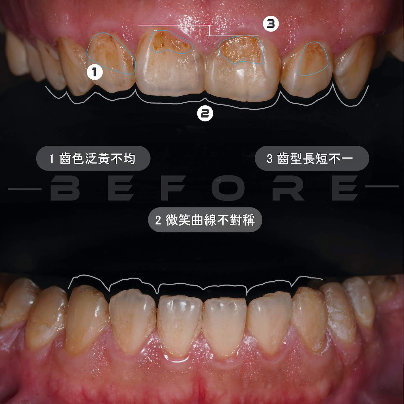 陶瓷貼片療程前的上下排牙齒近照，有牙齒泛黃顏色不均、齒型長短不一、微笑曲線不對稱等問題