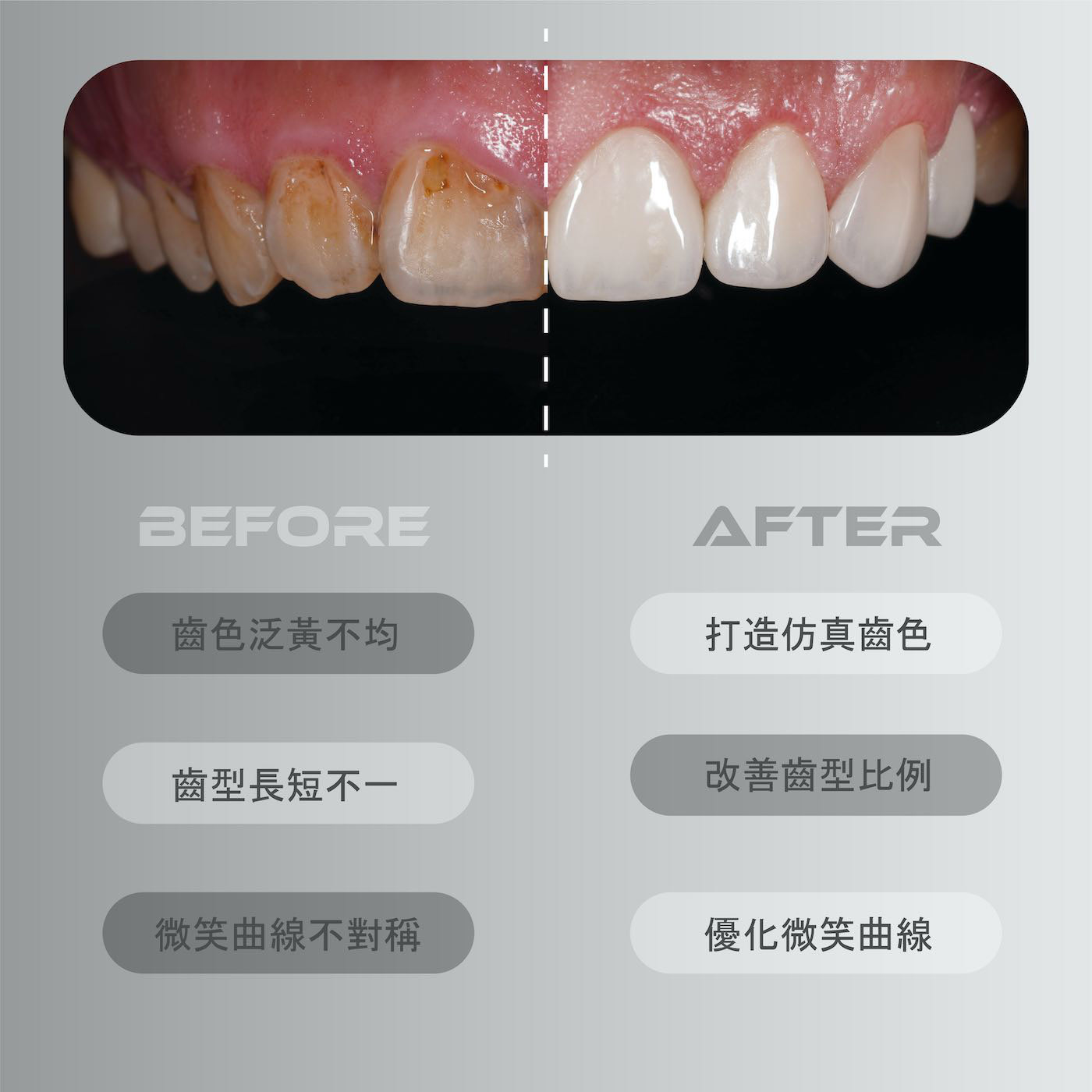 療程前有牙齒黃、牙齒顏色不均、牙齒長短不一、微笑曲線不對稱等問題；陶瓷貼片療程後打造仿真齒色、改善齒型比例並優化微笑曲線