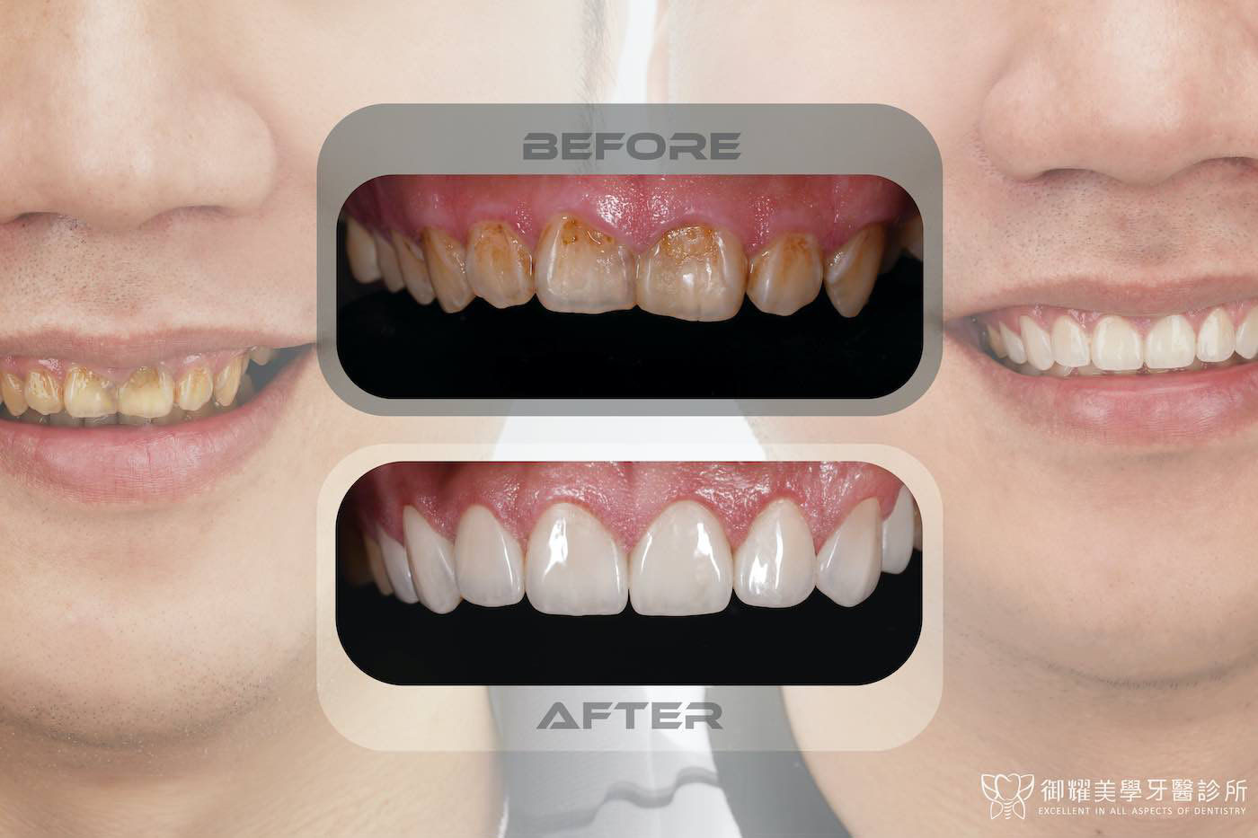 完成陶瓷貼片、水雷射牙冠增長術療程前後上排牙齒與笑容對比，一次改善牙齒黃、牙齒短小