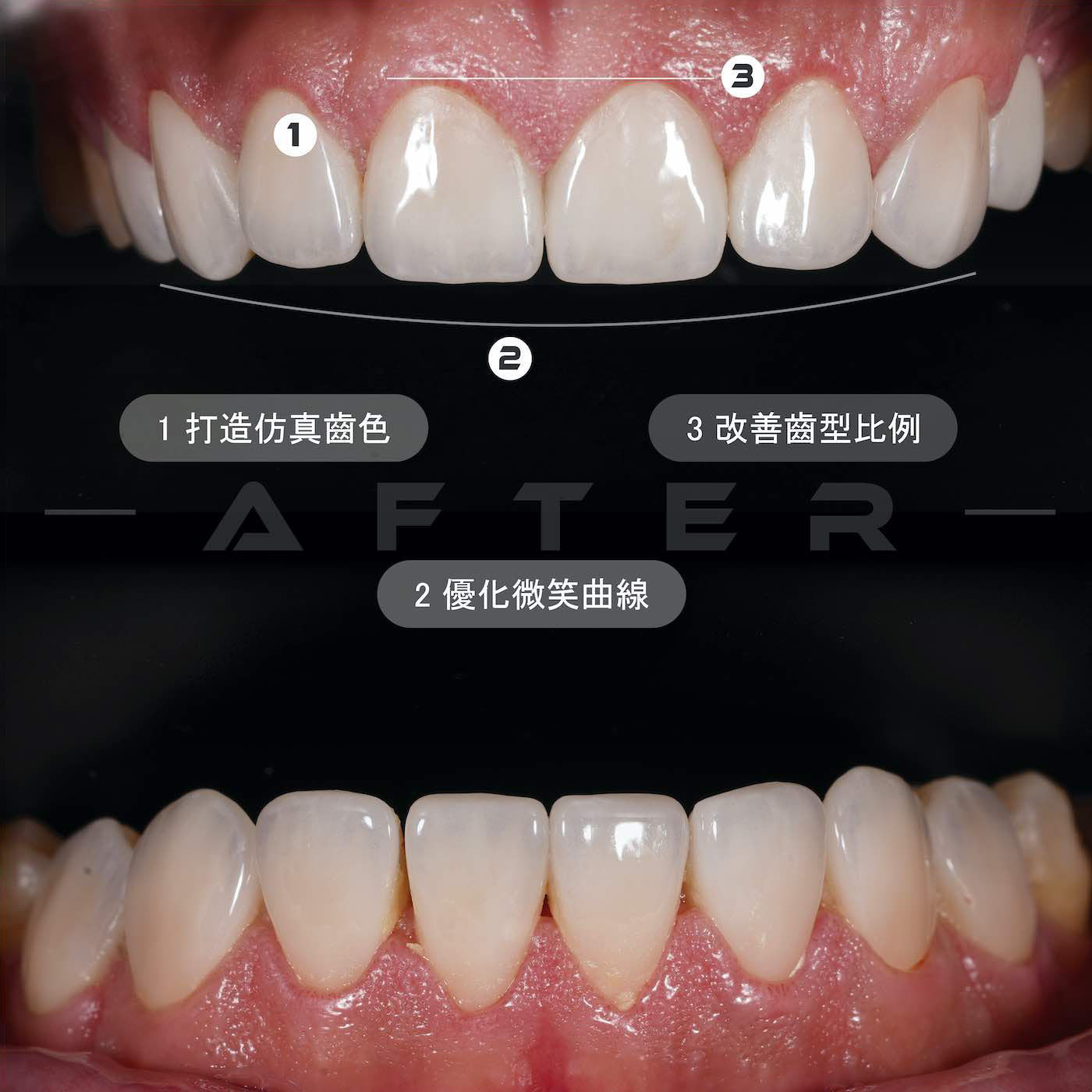 陶瓷貼片、水雷射牙冠增長術療程後上下排牙齒近照，牙齒變得白皙自然、改善齒型比例，微笑曲線更完美