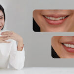 陶瓷貼片-牙齒貼片-一日美齒-推薦-台中-御耀美學牙醫