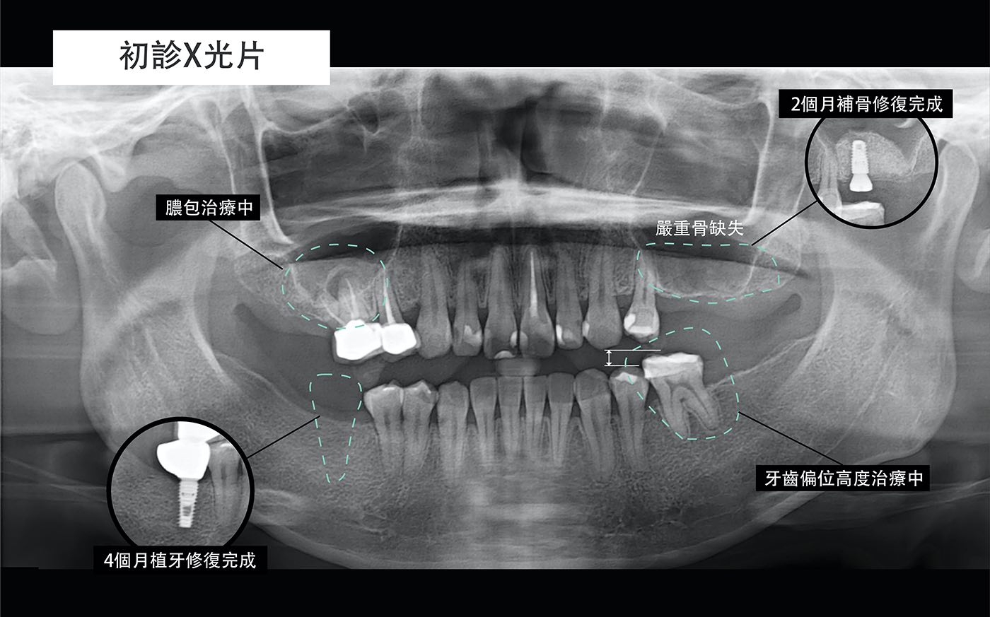 陶瓷貼片療程前拍攝的X光片，後牙有缺牙、齒槽骨流失等問題，先進行補骨與植牙修復