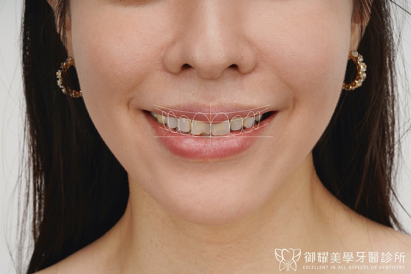 陶瓷貼片術前笑容，有牙齒顏色不均、側門牙長短不一、微笑曲線不夠飽滿等問題；在照片上先標出貼片完成後的牙齒外型與微笑曲線