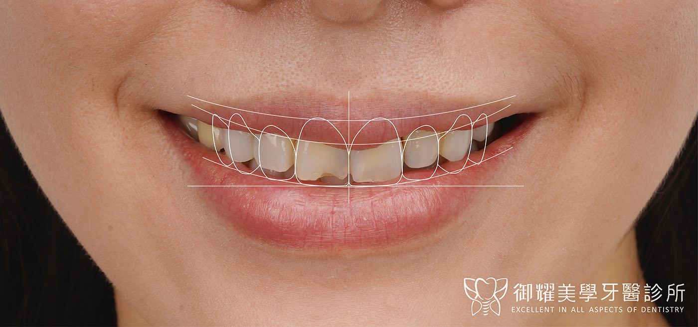 陶瓷貼片術前笑容特寫，在照片上先標出貼片完成後的牙齒外型與微笑曲線
