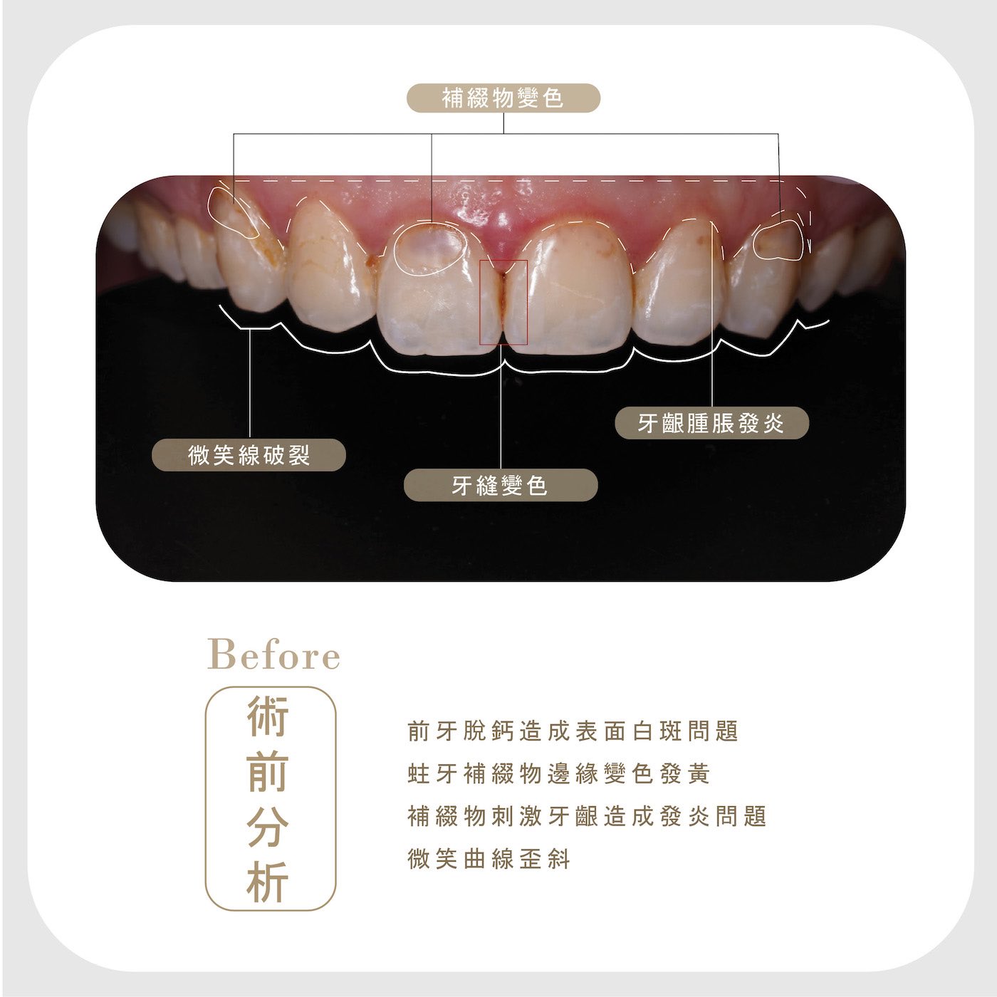 陶瓷貼片療程前上排牙齒外觀，有牙齒黃、脫鈣、補牙變色、牙齦發炎、微笑曲線破損尖銳等問題