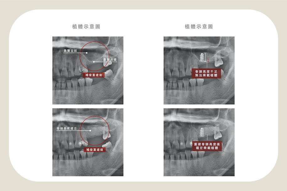 上顎後牙補骨前後比較與植體示意圖：補骨前骨頭高度不足無法乘載植體；補骨後重建骨頭高度可穩定乘載植體
