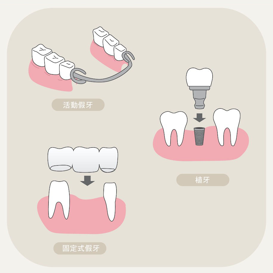缺牙處理方式示意圖：活動假牙、固定式假牙、植牙